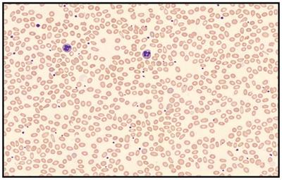 Case report: Whole-exome sequencing for a hereditary elliptocytosis case with an unexpectedly low HbA1c